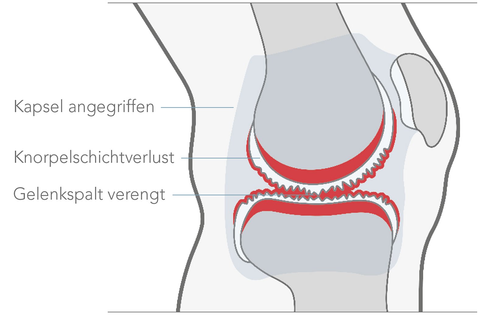 Arthrose Bild