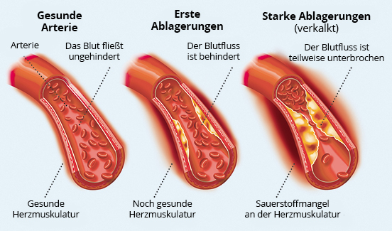 MyokardAterie Bild