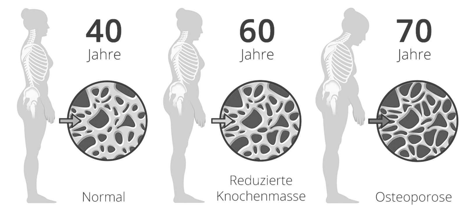 Osteoporose Bild